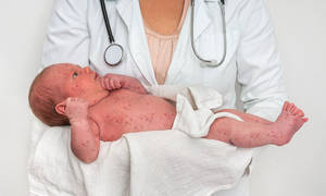 Η πιο σφοδρή επιδημία ιλαράς της τελευταίας 20ετίας